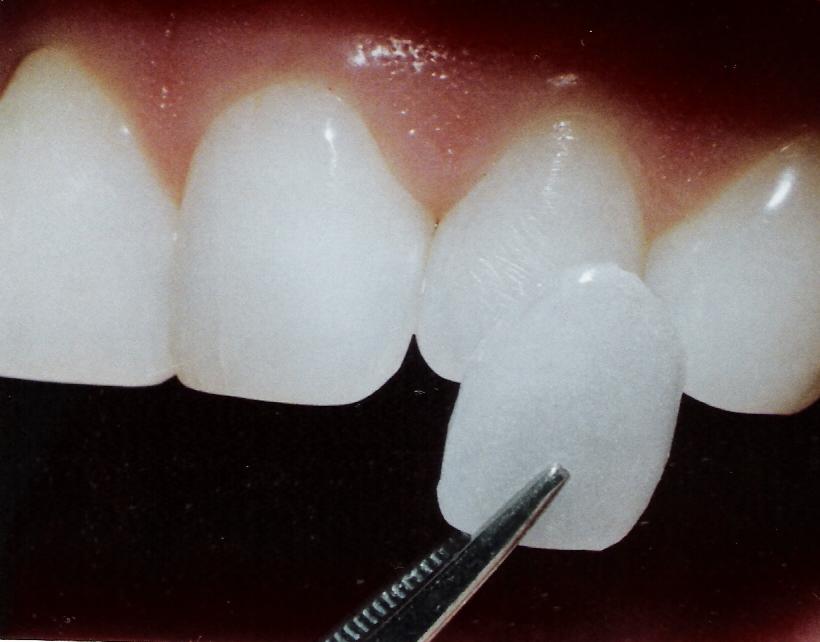 Las carillas dentales son estéticas, cómodas y mínimamente invasivas Las carillas dentales son estéticas, cómodas y mínimamente invasivas
