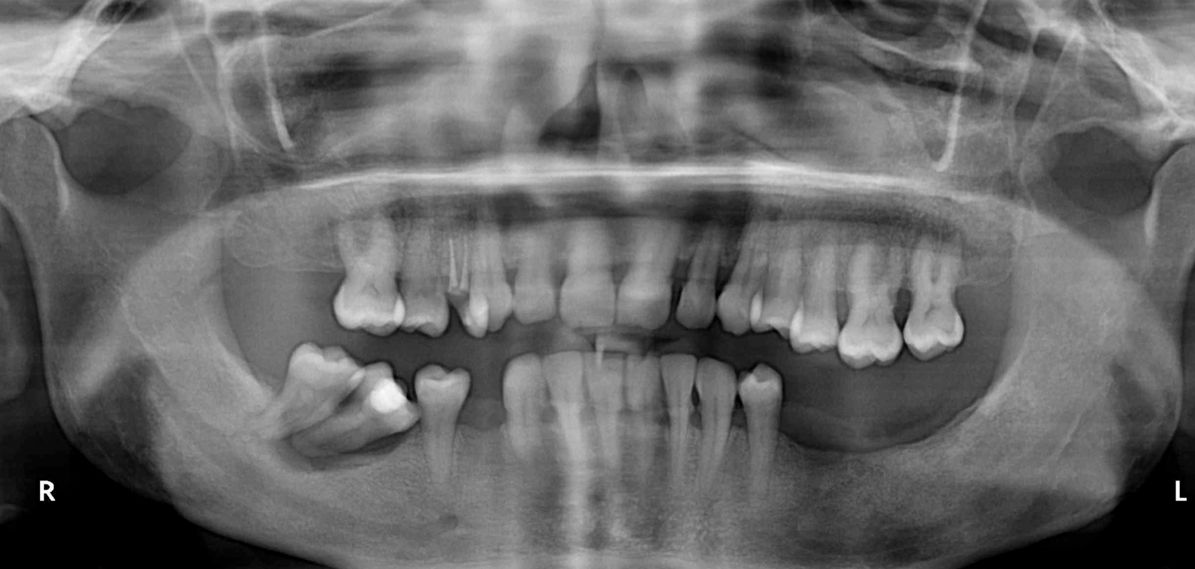 Ortopantomografía de un paciente que ha perdido piezas dentales