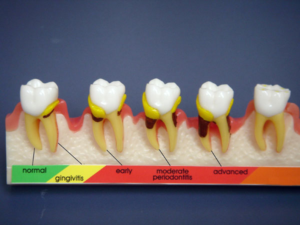 Controlling periodontal disease is of great importance in diabetic patients.