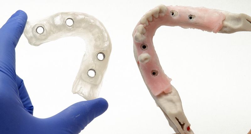 Una férula quirúrgica asegura la colocación de los implantes de forma predecible Una férula quirúrgica asegura la colocación de los implantes de forma predecible
