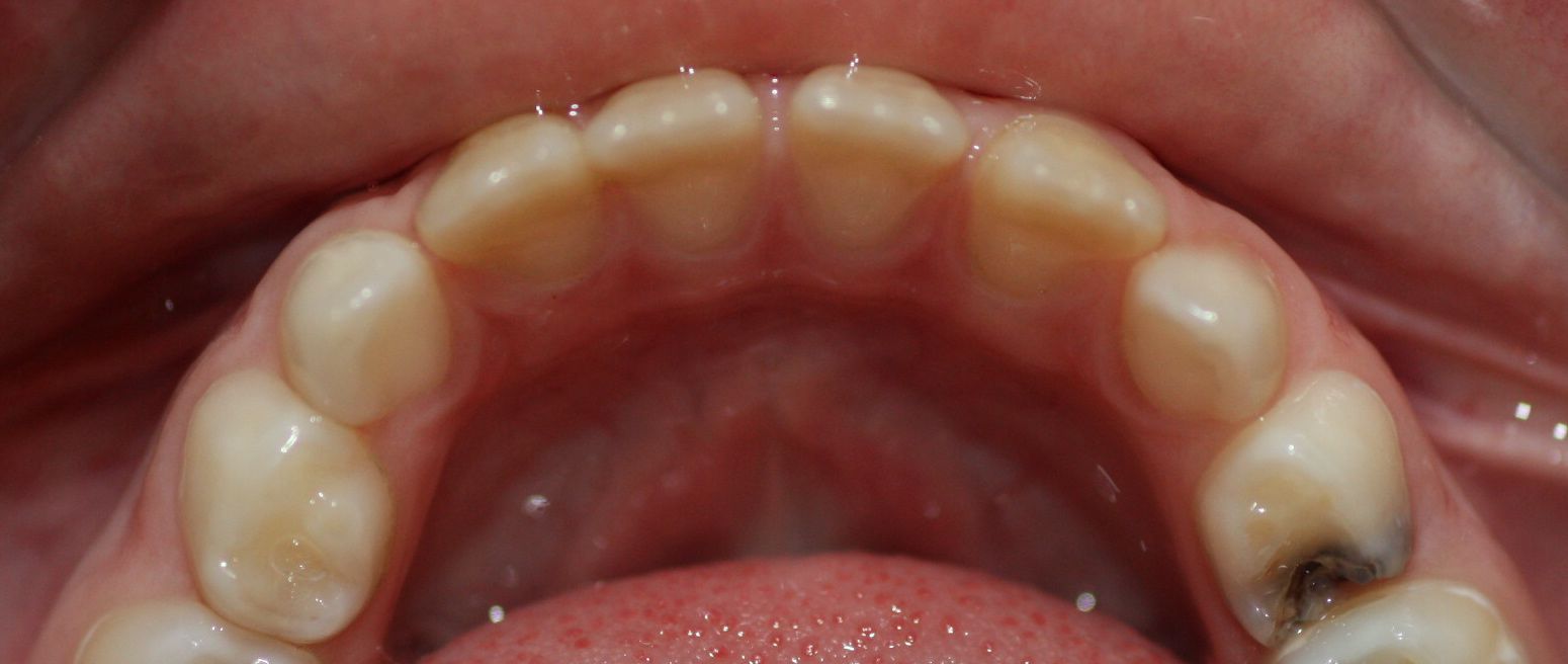 La muela con caries implica una pérdida de espacio para el premolar permanente que la reemplazará
