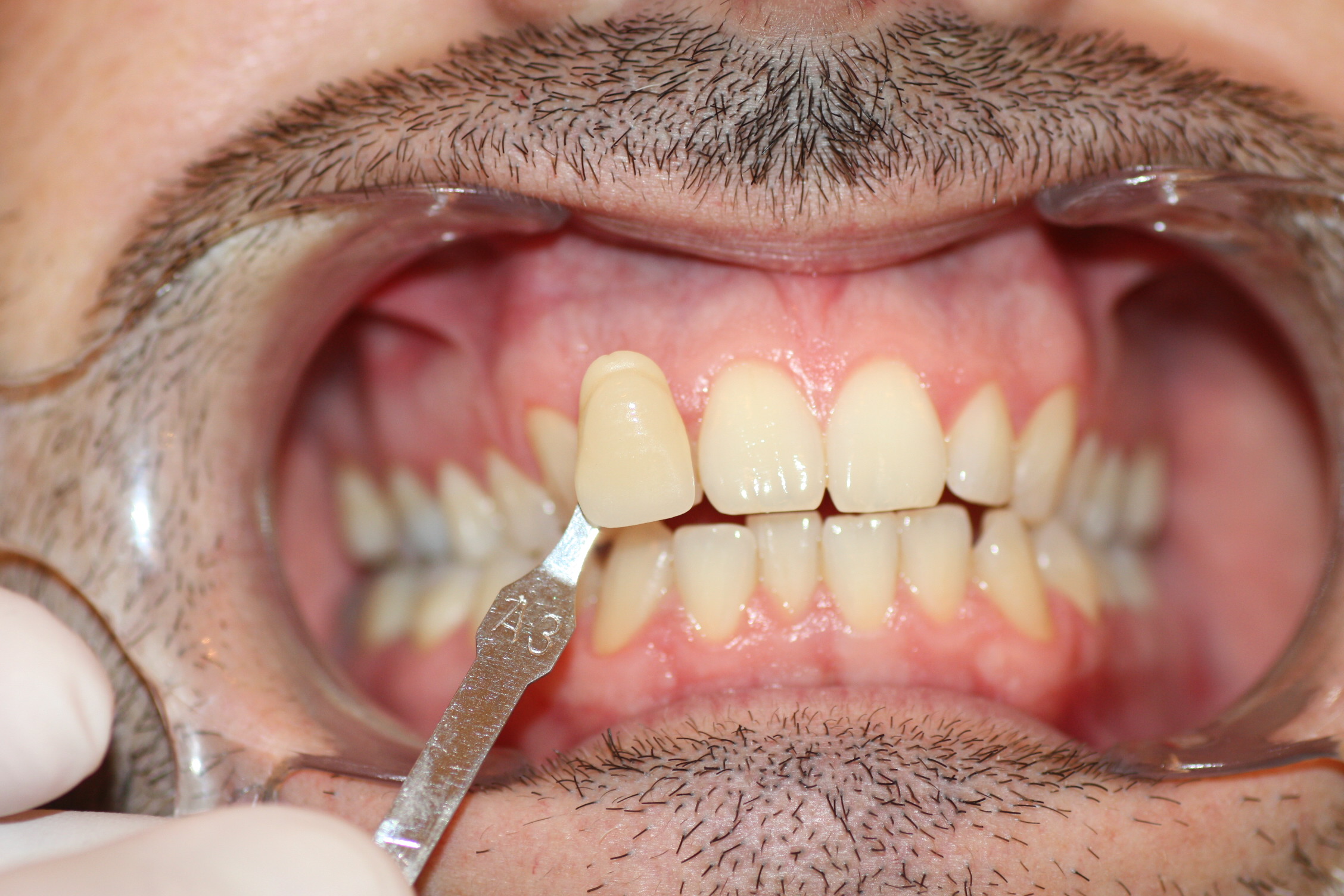 The patient's initial colour is established by means of a guide.