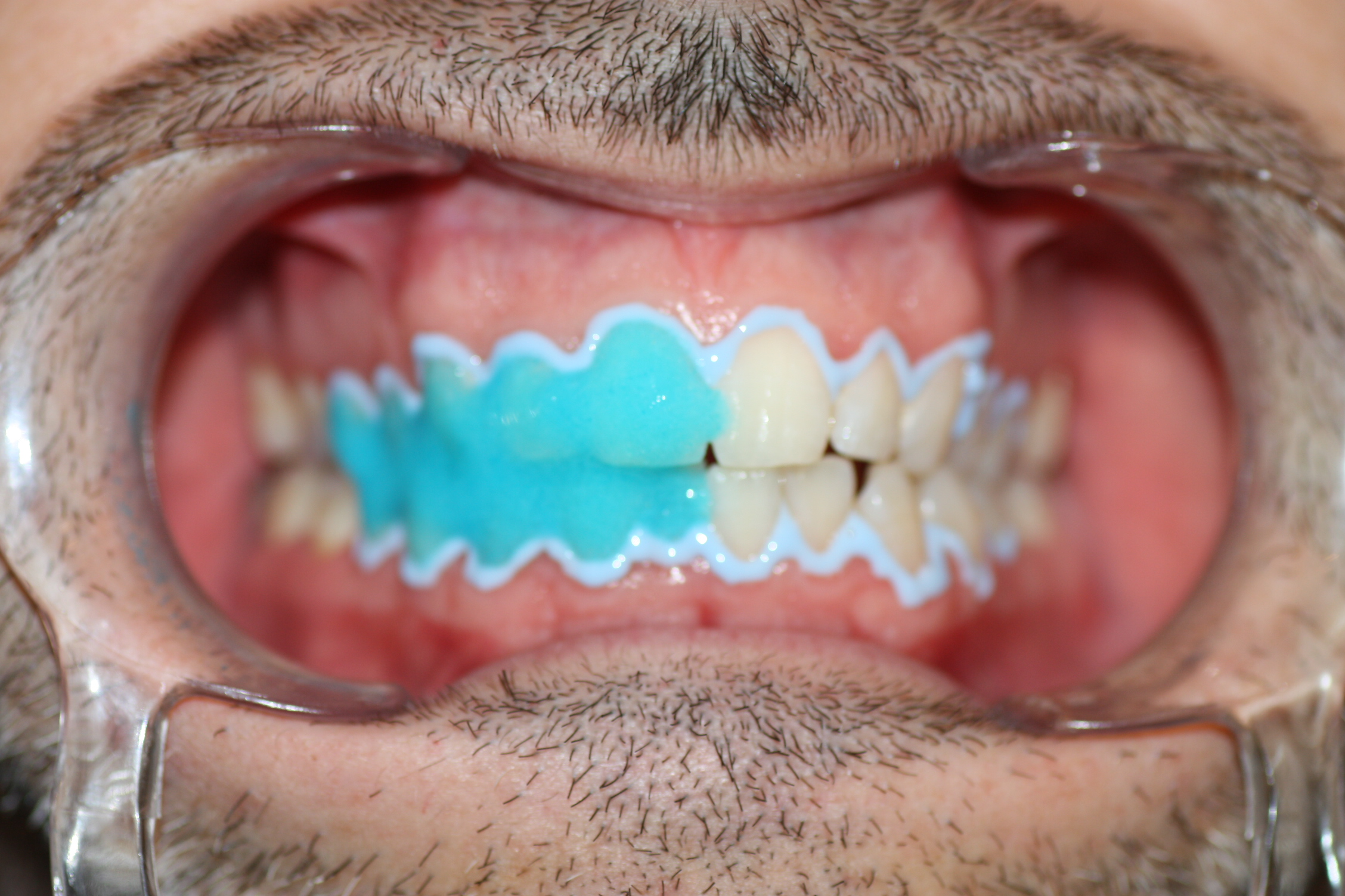 A gingival shield is applied and the bleach is applied.