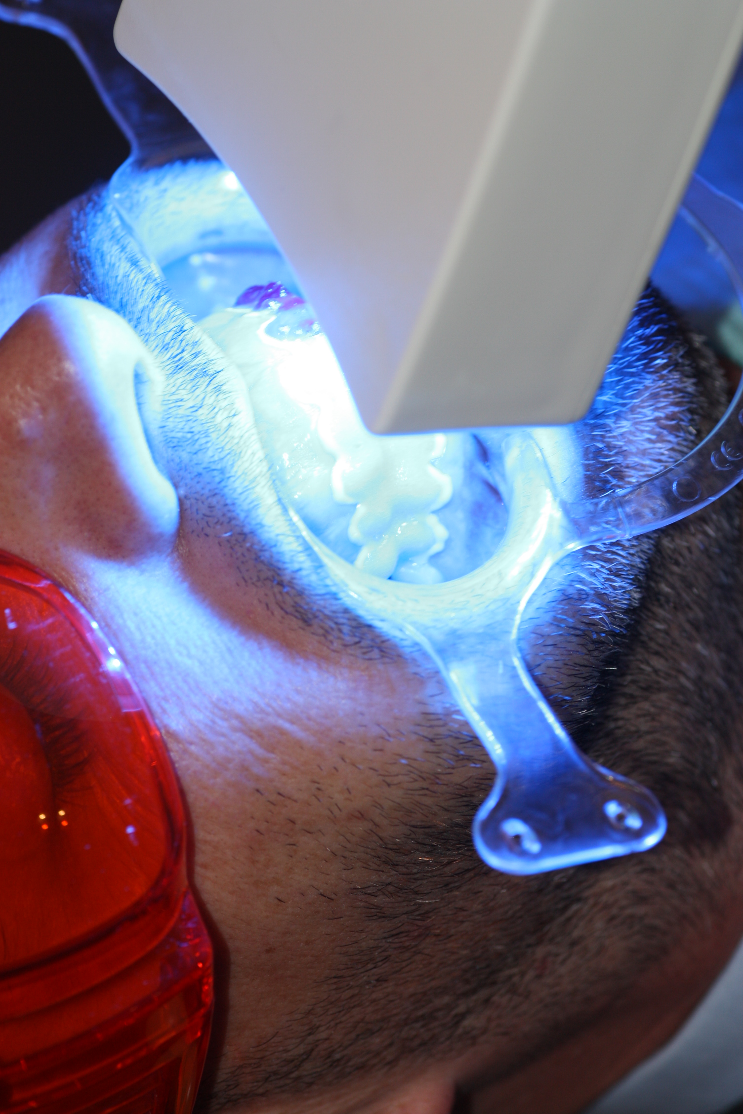 A specialised lamp accelerates the lightening reaction.