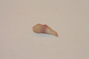 A temporary canine extracted prematurely