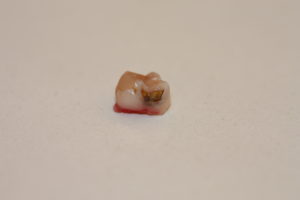 An exfoliated primary molar: we can see how it had a cavity.