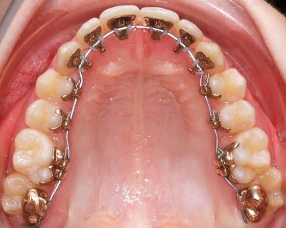Patients requiring comprehensive treatment can also use CAD/CAM lingual orthodontics.