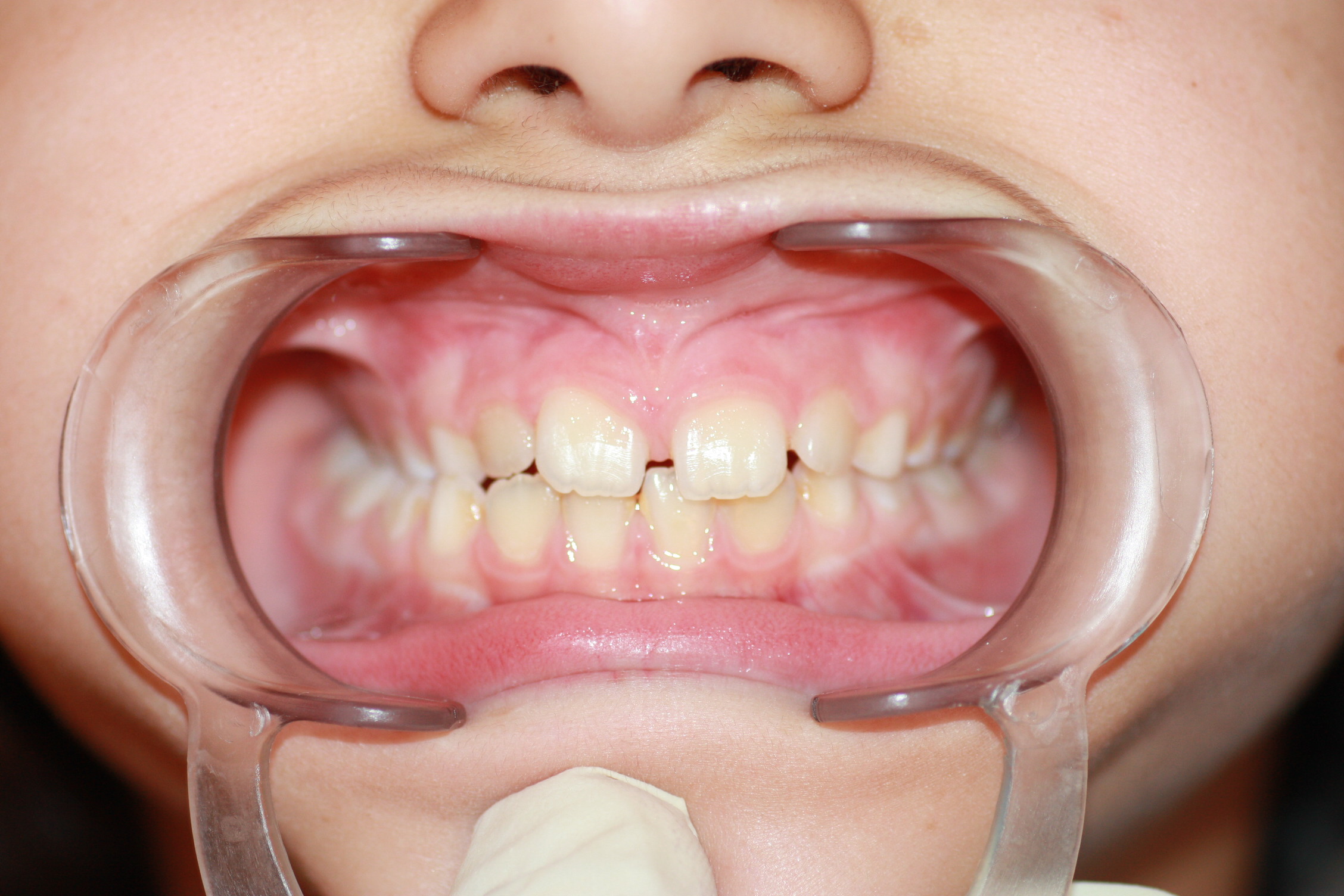 Obsérvese como en el lado izquierdo de la imagen los dientes superiores muerden 'por dentro' de los inferiores