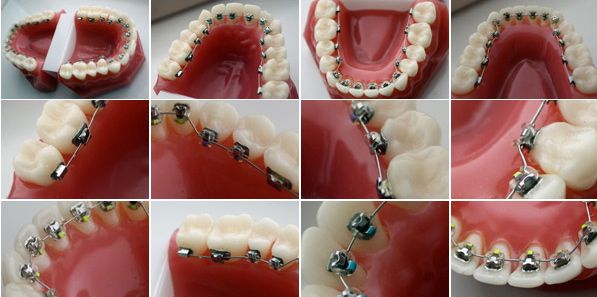 Los brackets se colocan estratégicamente en la cara interna de los dientes, de forma efectiva y discreta