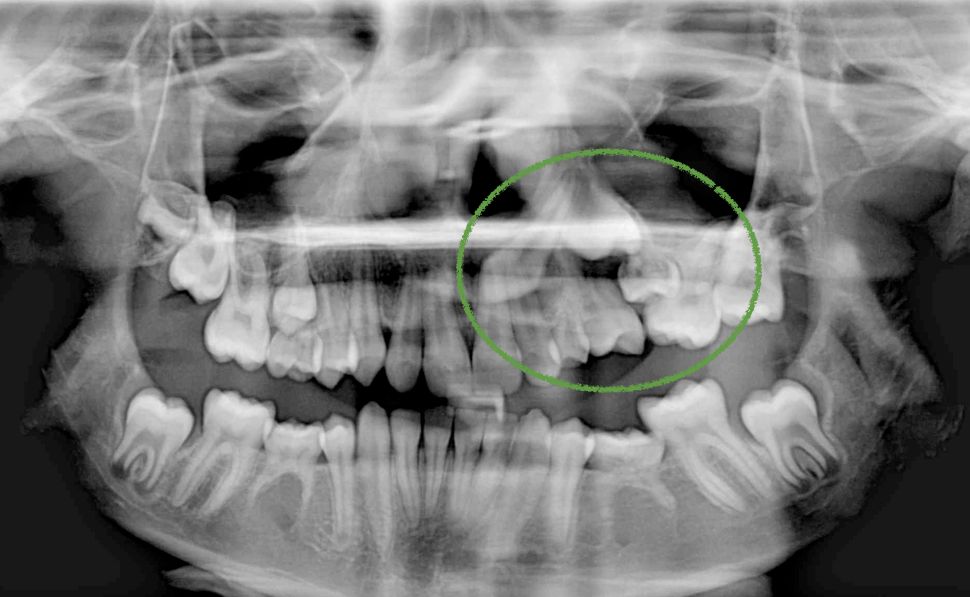 Una extracción prematura puede acarrerar graves problemas dentarios