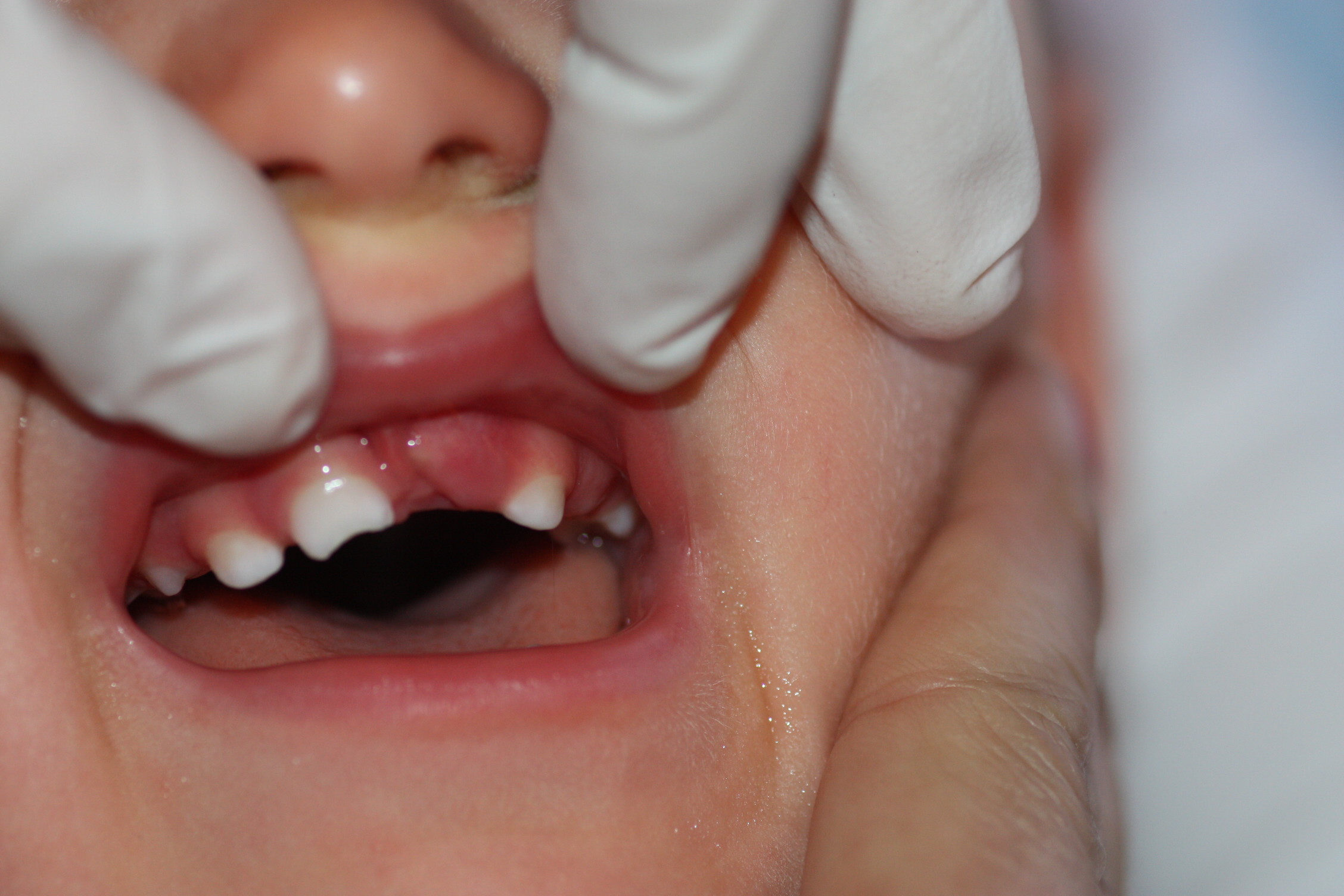 Tooth fracture secondary to trauma: no tooth crown visible