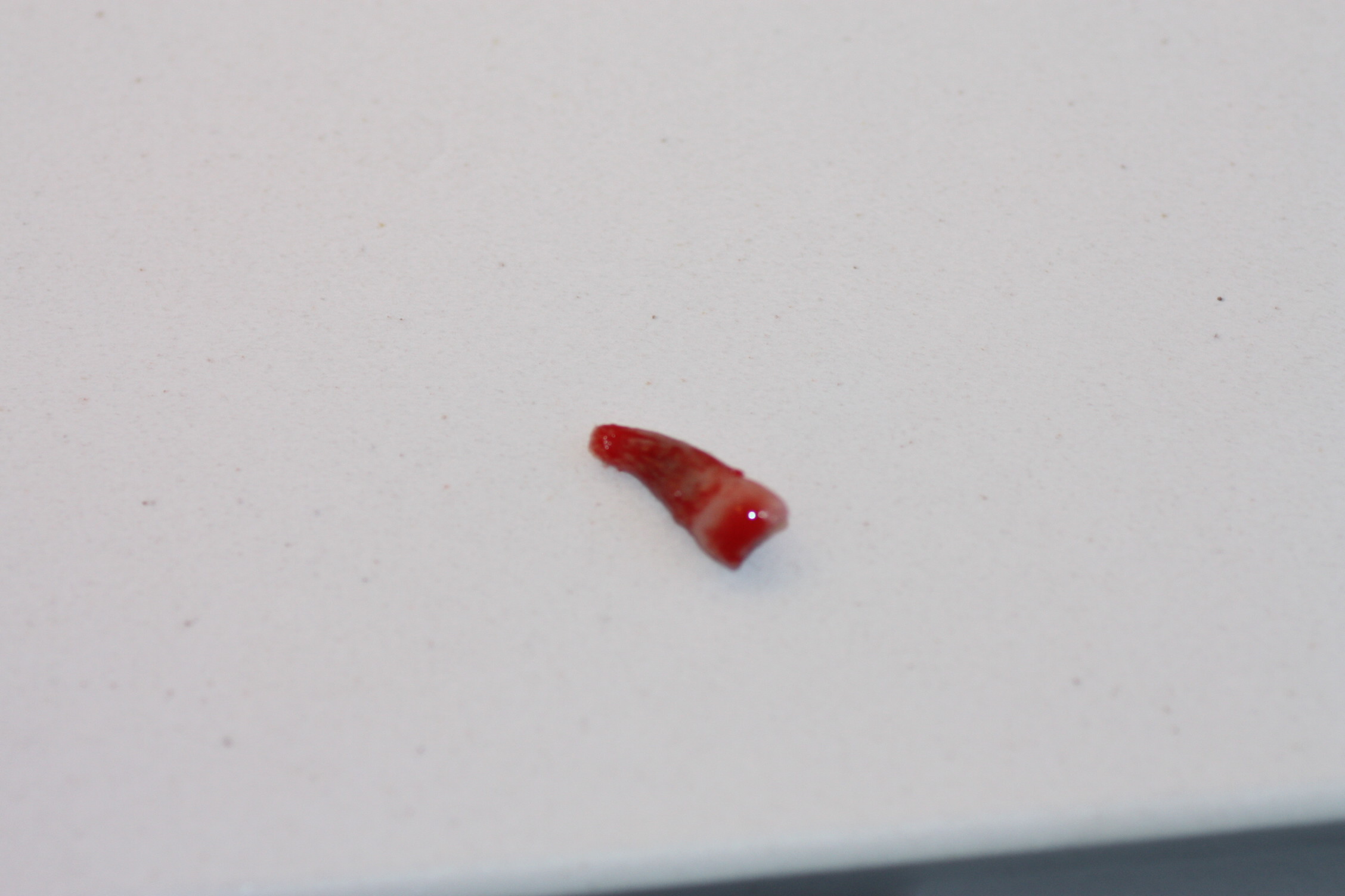 Image of an extracted upper central temporal incisor after a traumatic injury