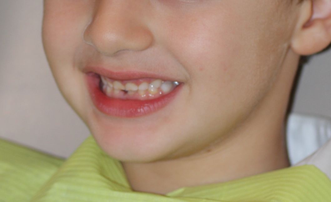 Los dientes en formación se hacen más resistentes con la aplicación periódica de flúor tópico