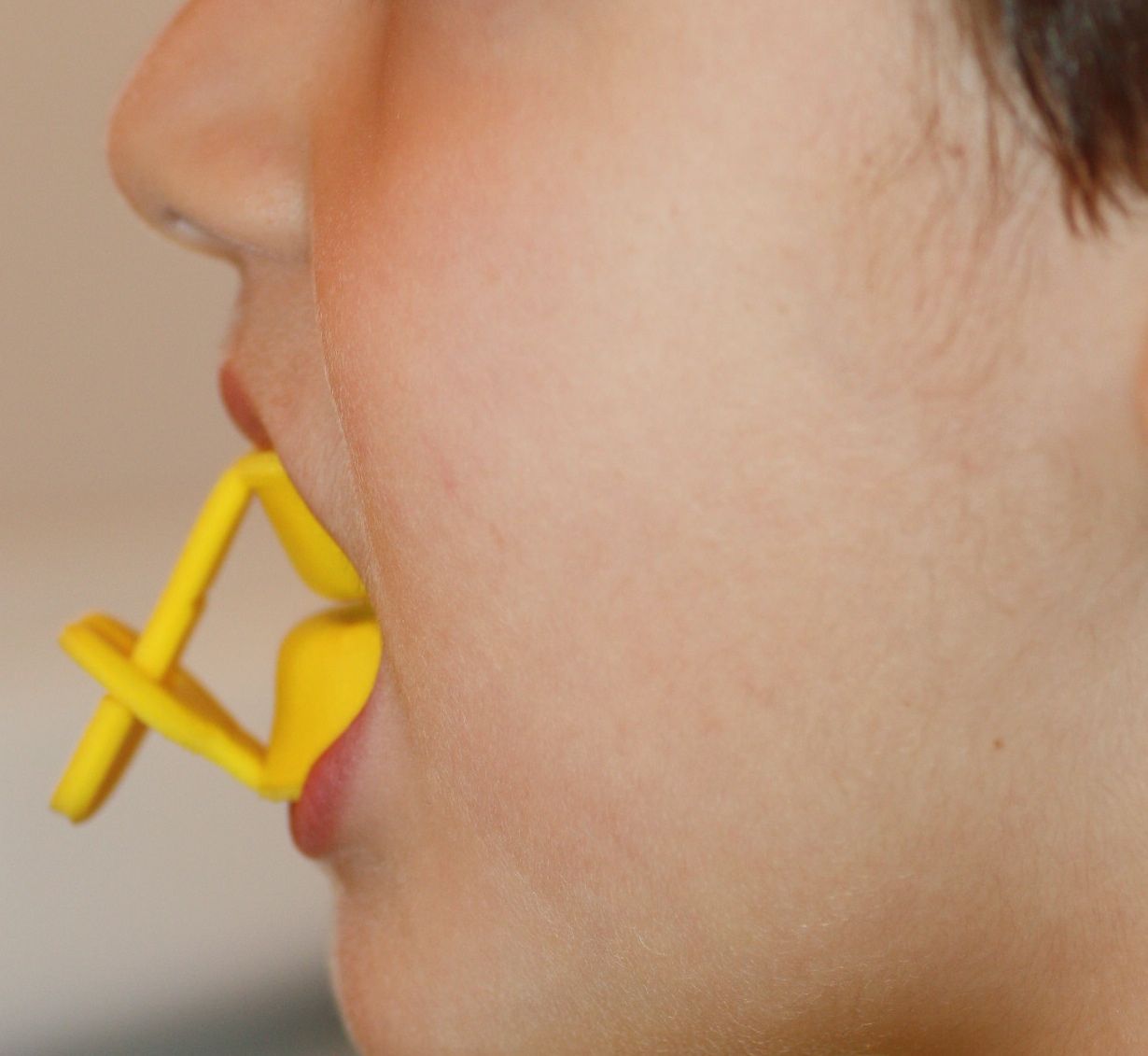 El odontopediatra de cada niño valorará su riesgo de caries y sus necesidades de fluoración