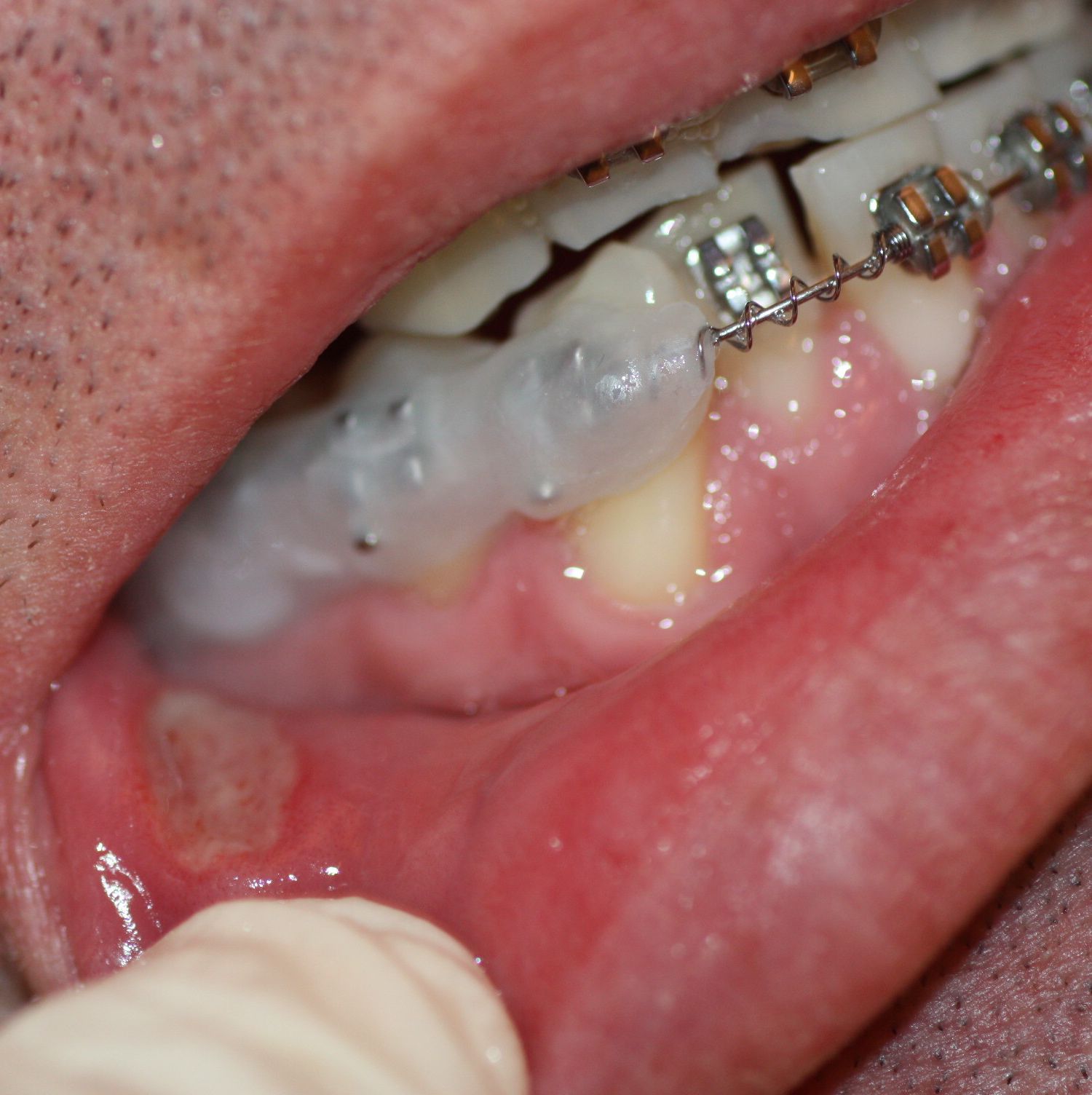 Cera aplicada en brackets que lesionan la mucosa yugal