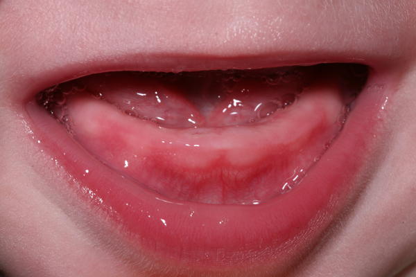 Teeth about to erupt