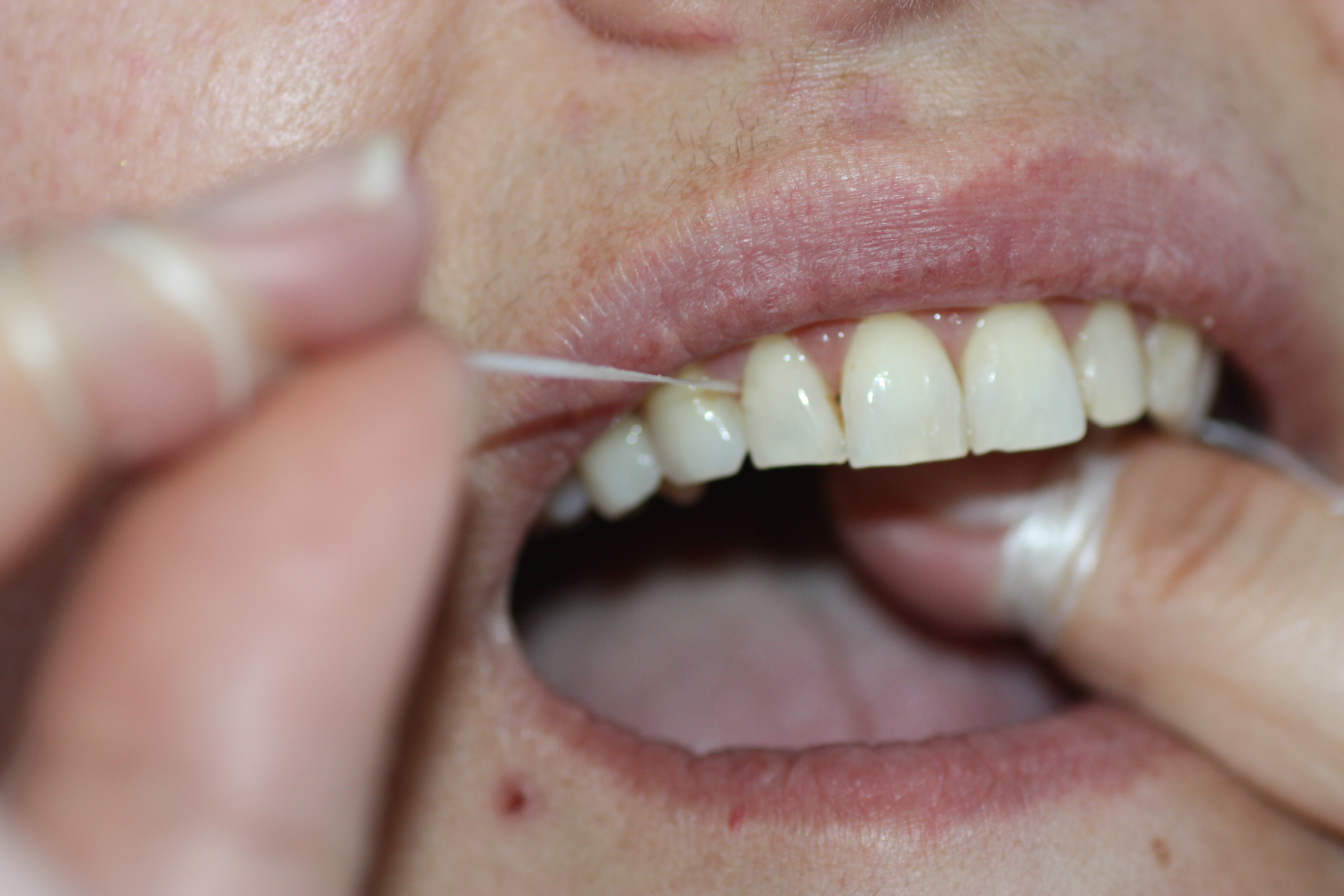 "Enrollado" en los dedos, el hilo dental se pasa entre los puntos de contacto de todos los dientes para eliminar restos de comida entre ellos
