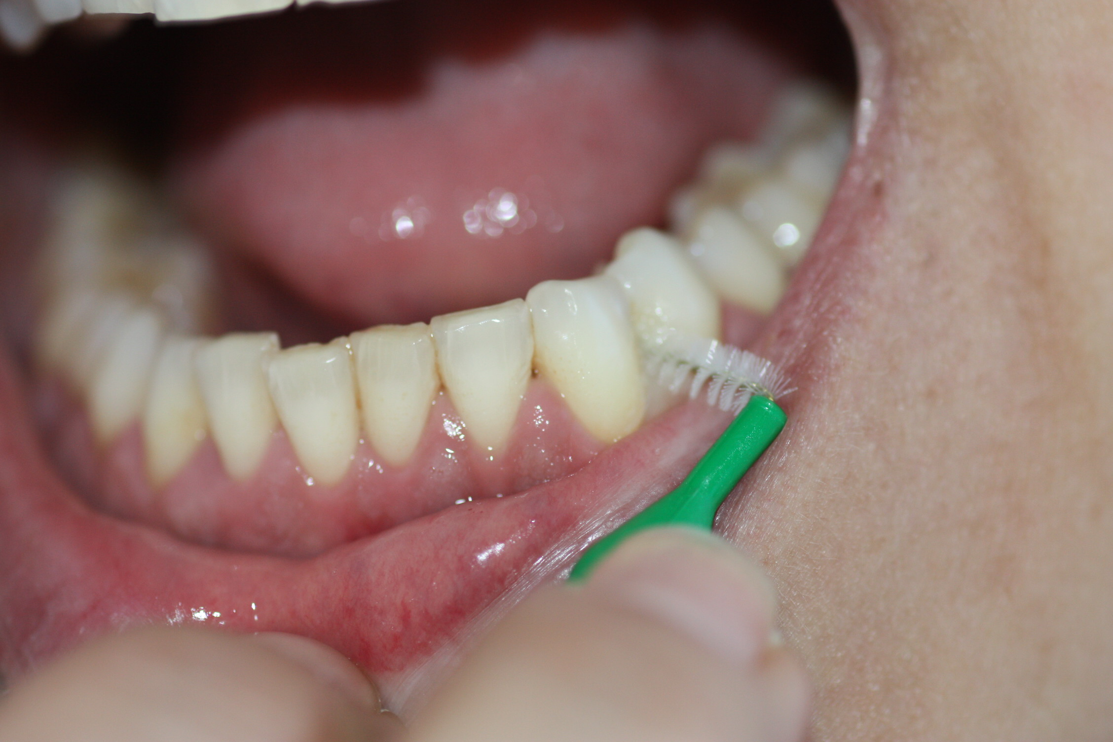 El cepillado interproximal es imprescindible en pacientes con periodontitis y puentes cerámicos
