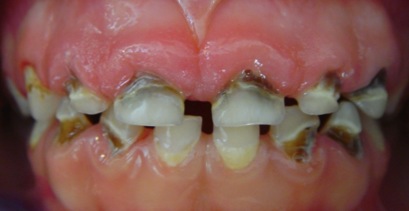 La caries 'rampante' tiene una prevalencia cada vez mayor en bebés