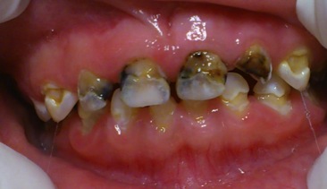 Caries de aparición temprano en estado muy avanzado