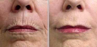 El efecto 'código de barras' perioral tratado con microfillers por un dentista ofrece un resultado agradable, natural y rejuvenecido