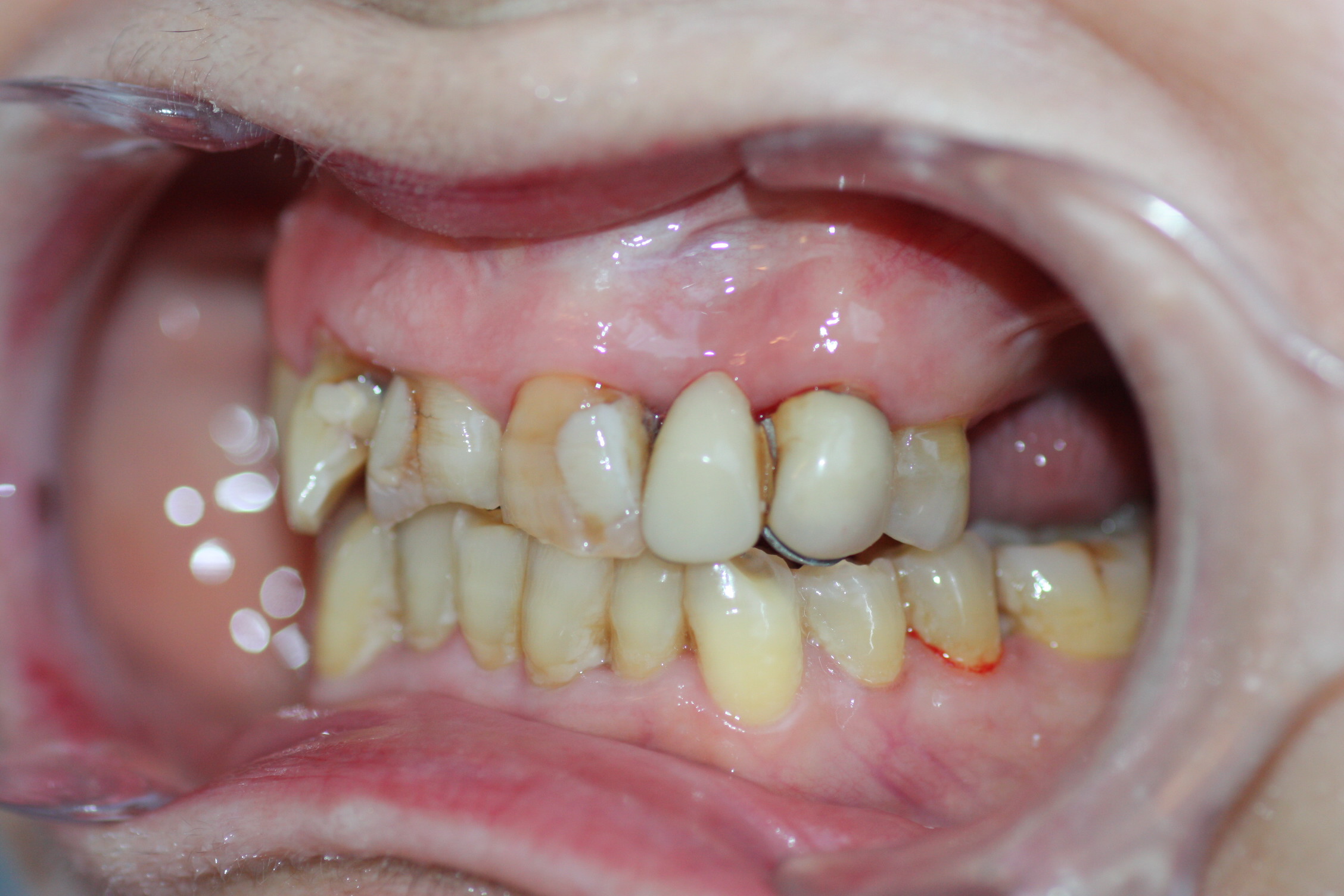 En este caso necesitamos planificar una rehabilitación integral que mejore la estética de todos los dientes, para lo que se prevé un tratamiento con ortodoncia y prótesis fijas
