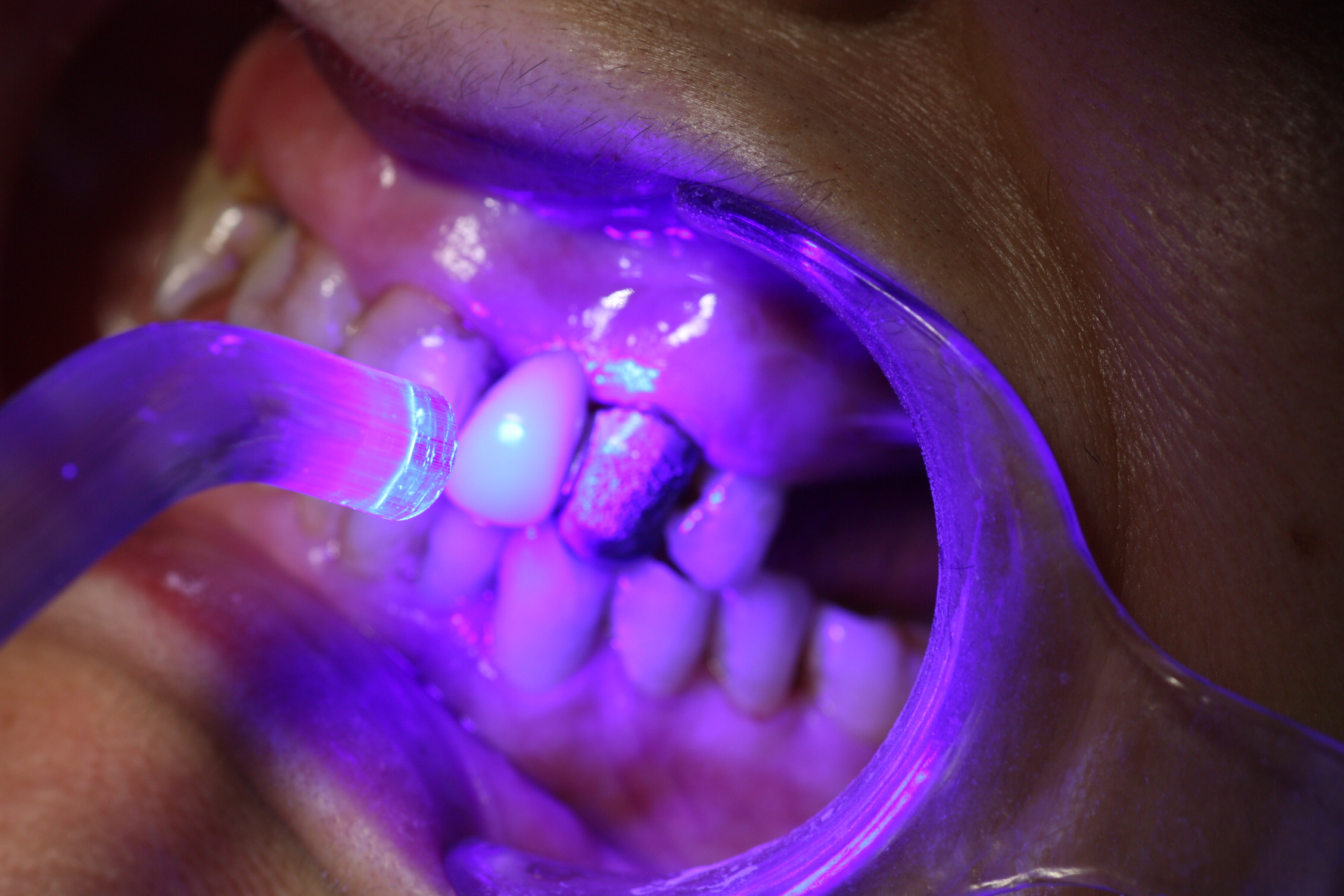 Una vez aplicados los agentes adhesivos, polimerizamos el diente durante 40 segundos para garantizar el adecuado funcionamiento de los mismos