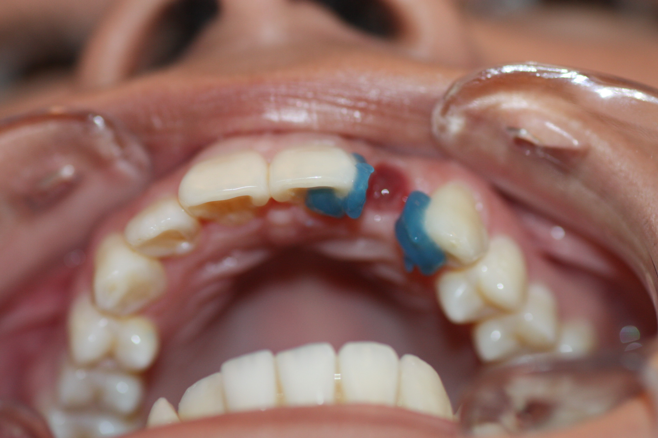 Grabamos las superficies de los dientes adyacentes con ácido ortofosfórico al 37% para garantizar una buena adhesión de nuestro provisional