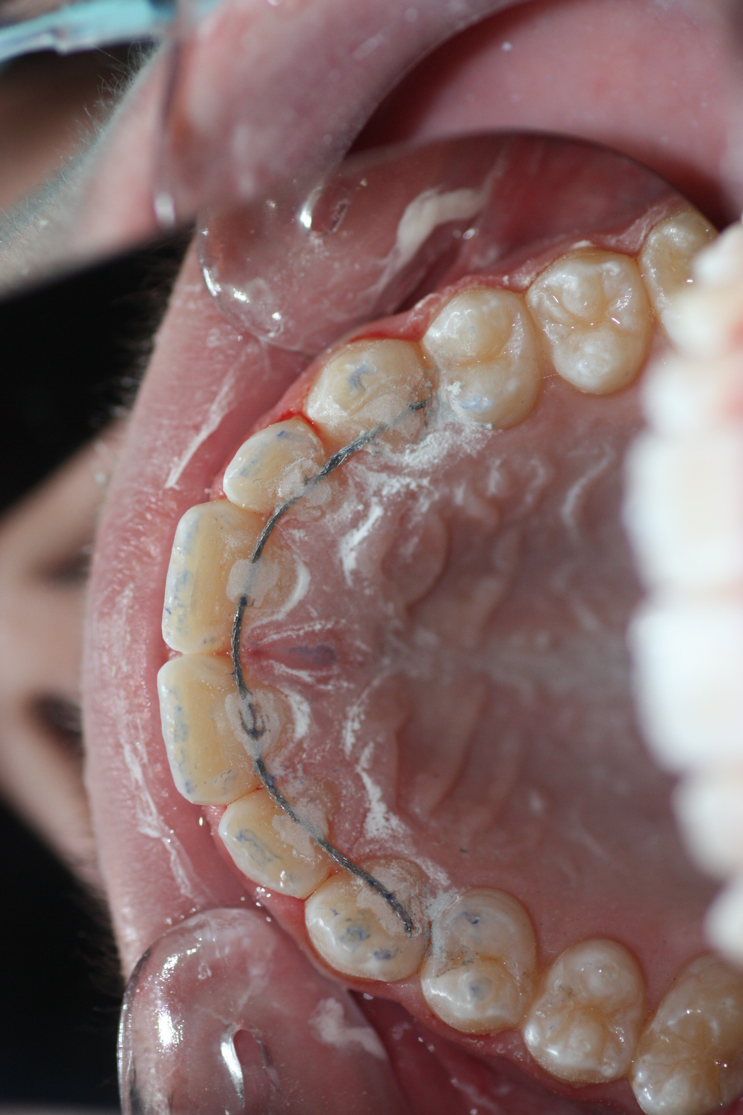 It is important to make an occlusal adjustment so that the patient can bite with nromality despite retention.