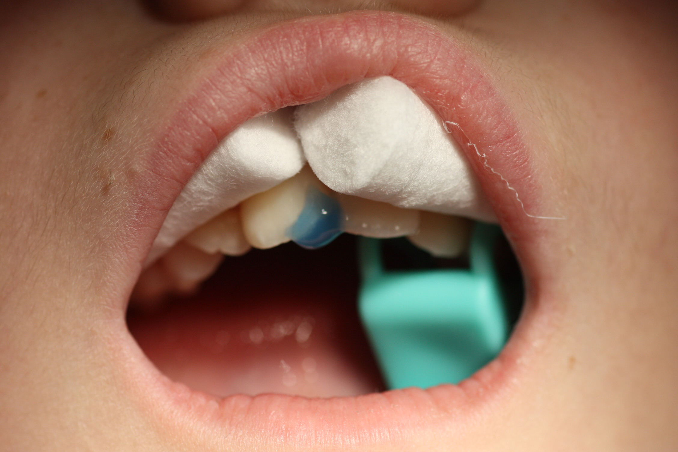 Grabamos la superficie con ácido ortofosfórico al 37% durante 40 segundos, para acondicionar el diente