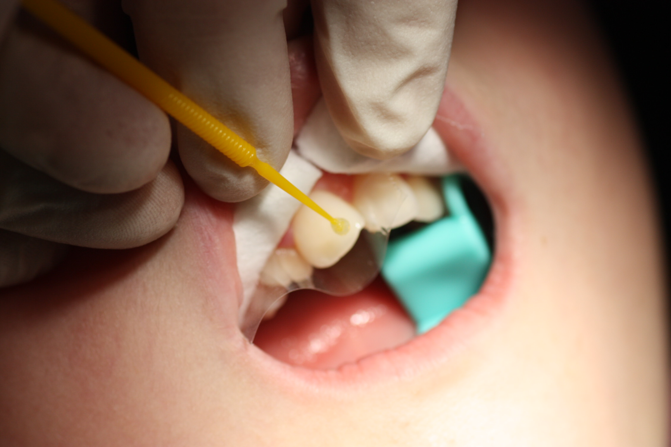 Utilizamos un adhesivo líquido de dos pasos para garantizar la máxima retención de la restauración al diente, que aplicaremos con un pequeño cepillo. Una vez aplicado el segundo paso, polimerizamos esta superficie con una lámpara dental.