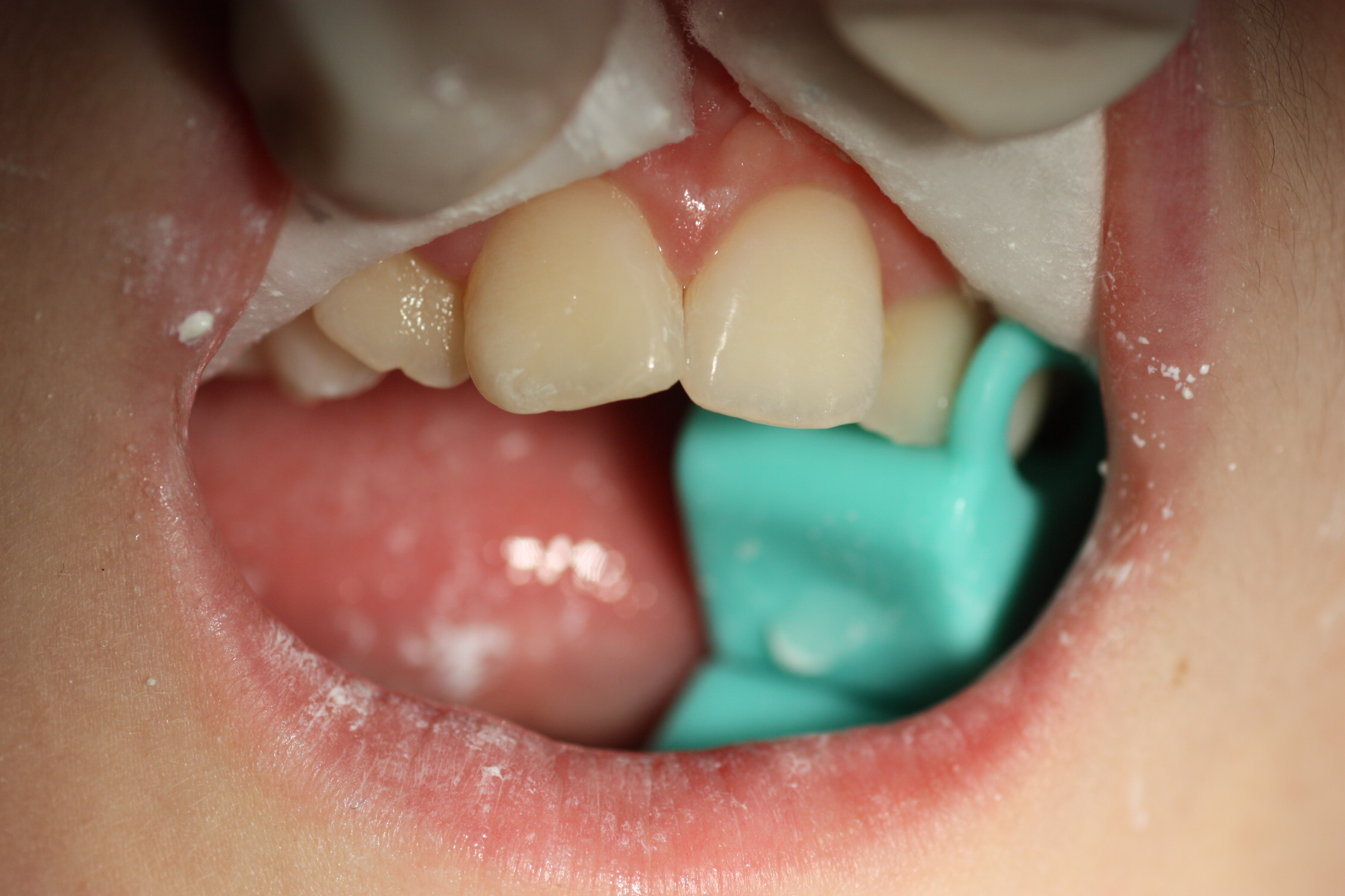 Finalmente, y tras un sencillo pulido, el paciente puede regresar a casa con su anatomía dental intacta, y disfrutar de su vida como si nada hubiera pasado.