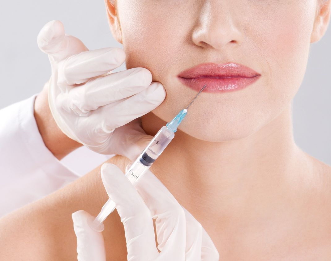 La aplicación de microfillers por parte del dentista es rápida, cómoda y muy efectiva