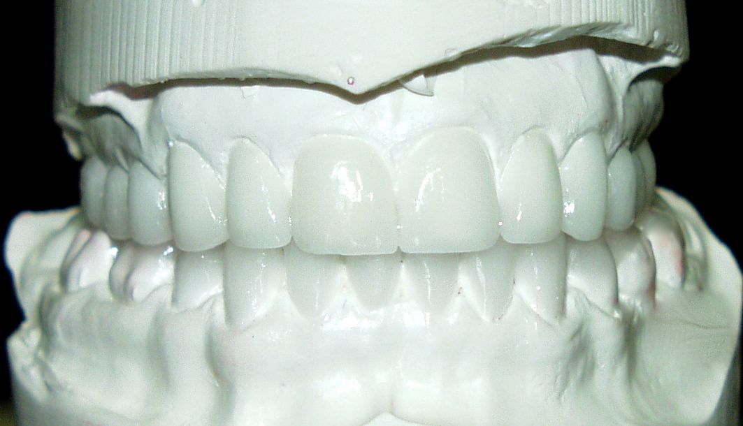 El encerado diagnóstico de carillas dentales permite que el paciente vea cómo serán sus dientes antes de empezar el tratamiento