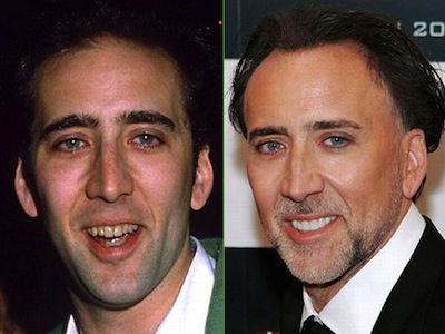 Nicholas Cage, protagonista de películas como 'La Roca', escogió las carillas dentales como método para mejorar su estética facial Nicholas Cage, protagonista de películas como 'La Roca', escogió las carillas dentales como método para mejorar su estética facial