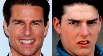 Tom Cruise, uno de los actores más famosos de Hollywood, mejoró radicalmente su sonrisa tras saltar a la fama Tom Cruise, uno de los actores más famosos de Hollywood, mejoró radicalmente su sonrisa tras saltar a la fama