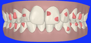 Los ataches se diseñan en el software de planificación y después se colocan al paciente en un color idéntico al del diente