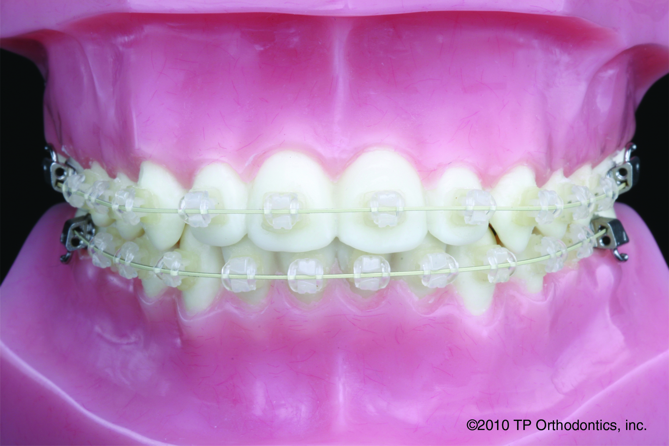Brackets Cerámicos TipEdge PLUS