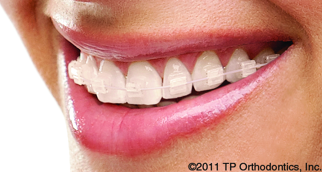 Apariencia estética de los brackets Click-It en boca