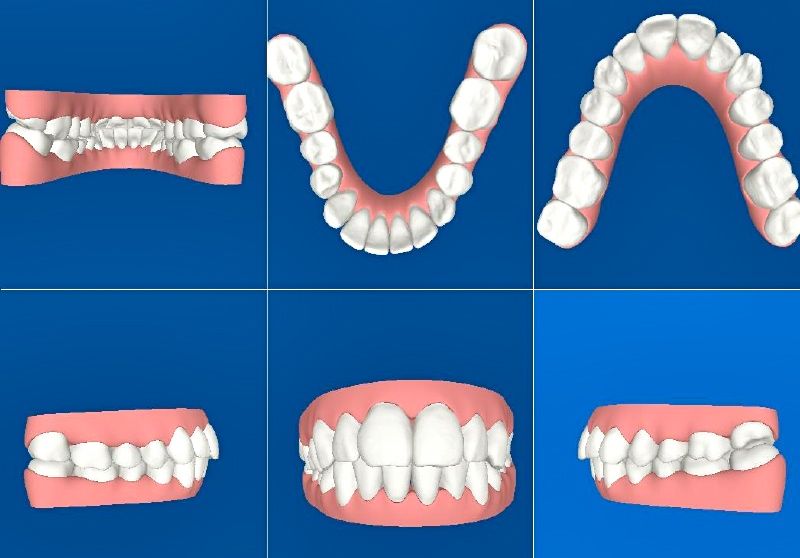 El Clincheck de planificación Invisalign es una extraordinaria herramienta informática de planificación