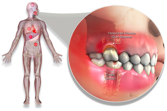 El vínculo entre diabetes y enfermedades periodontales está ampliamente descrito