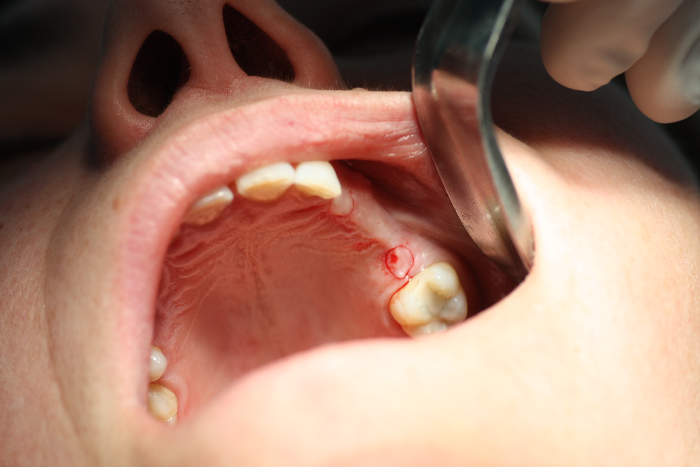 Incisión mínimamente invasiva para implante dental