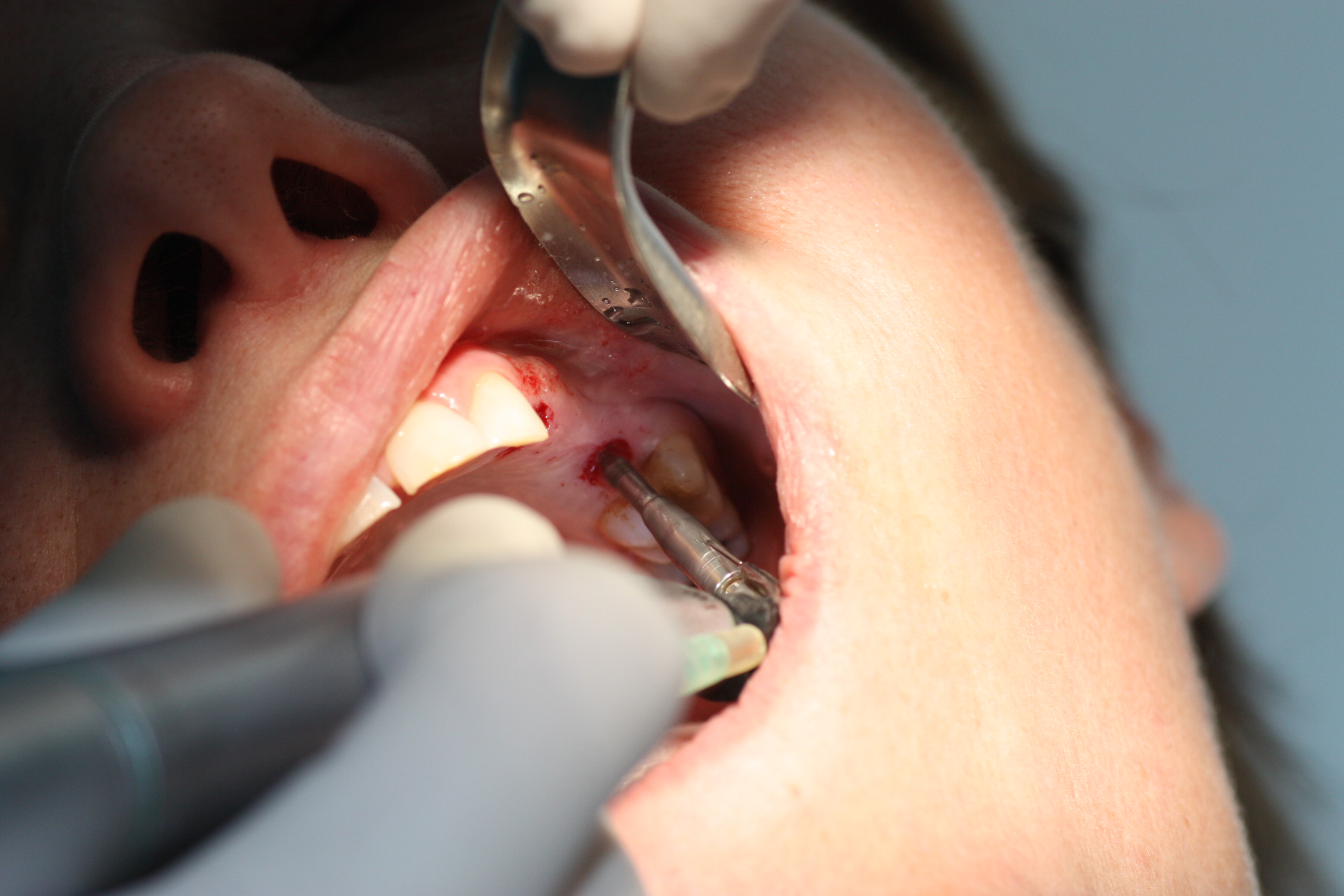 Preparación lecho implantológico para rehabilitación dental