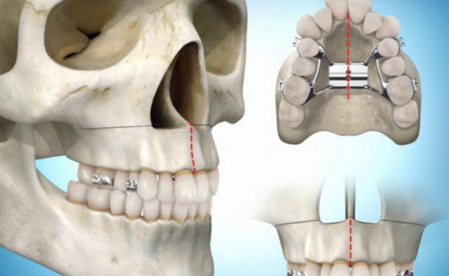 Las pequeñas incisiones a nivel óseo junto con el disyuntor ayudarán a generar el espacio necesario en el maxilar superior
