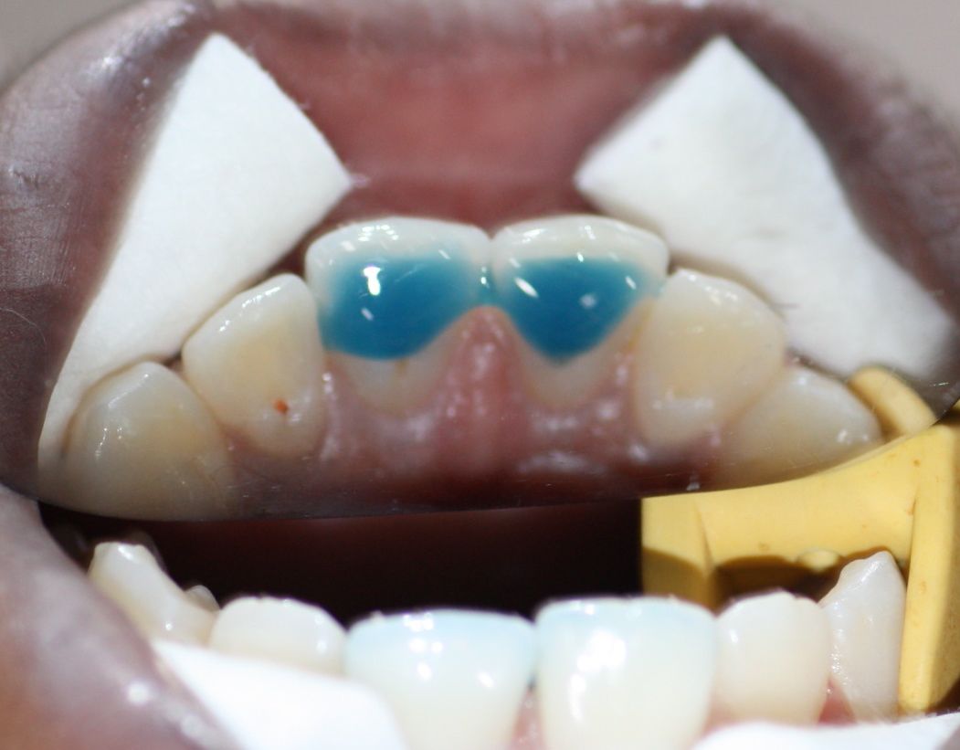 Grabado con gel ortofosfórico de la parte interior de los dientes superiores