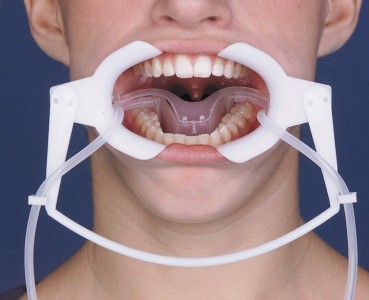 Aislamiento con retractor-aspirador de Nola
