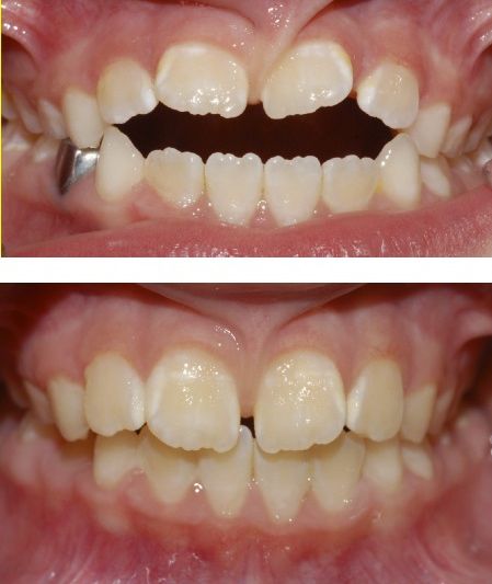 Efectos sobre un paciente de 7,1 años de edad, antes y después del uso de Tongue Tamer