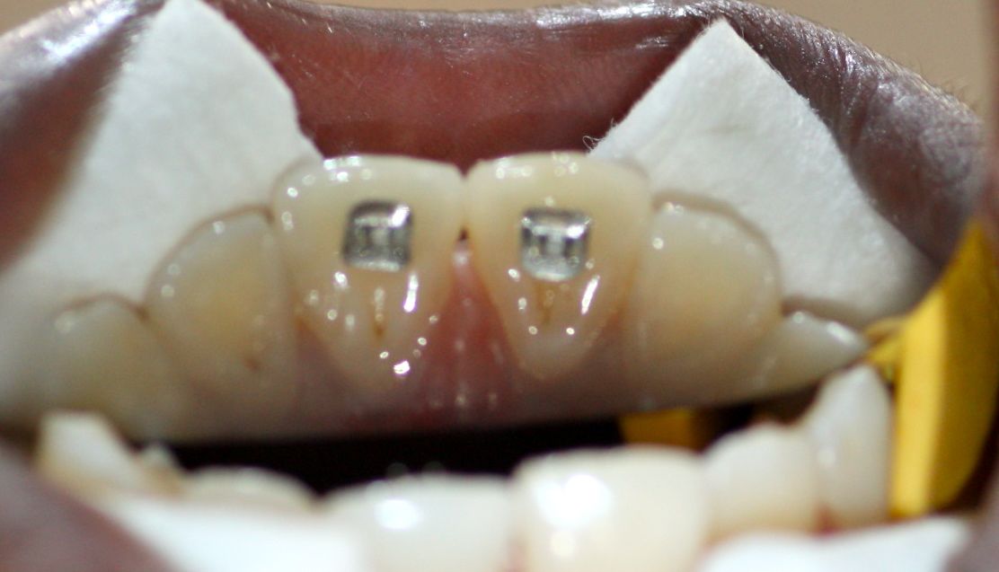 Colocación del Tongue Tamer y polimerización