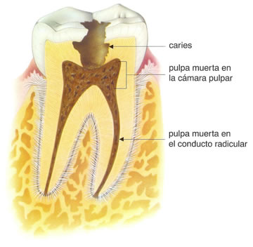 Cuando la caries llega al nervio suele ser necesario hacer una endodoncia