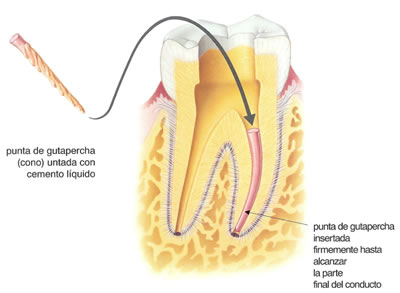 La guttapercha Maillefer es un excelente material de obturación dentro de los conductos dentarios